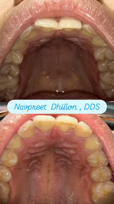 Before and after smile transformation 1