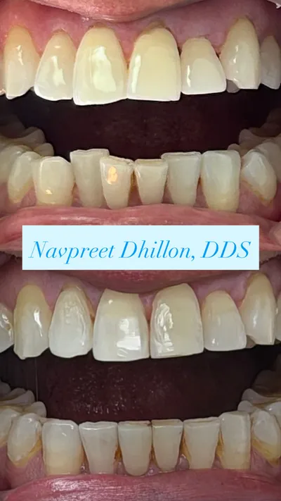 Before and after smile transformation 2