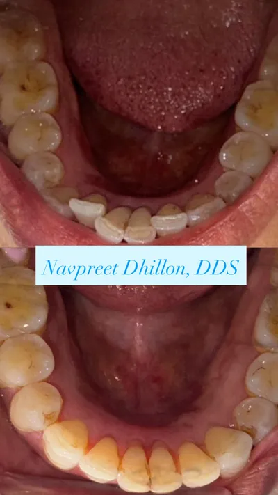 Before and after smile transformation 3