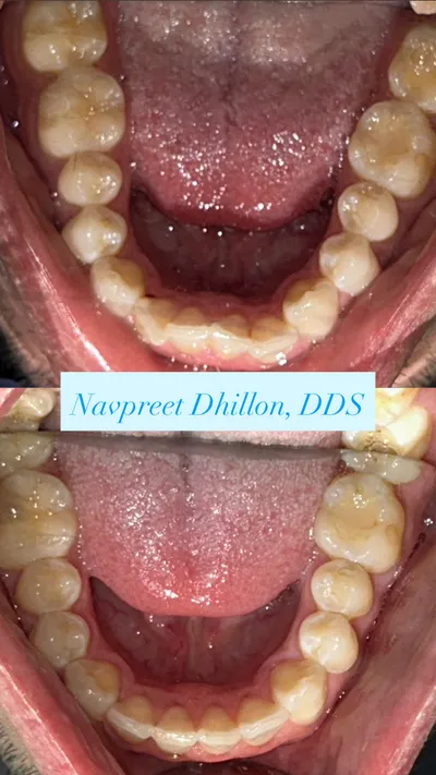 Before and after smile transformation 4