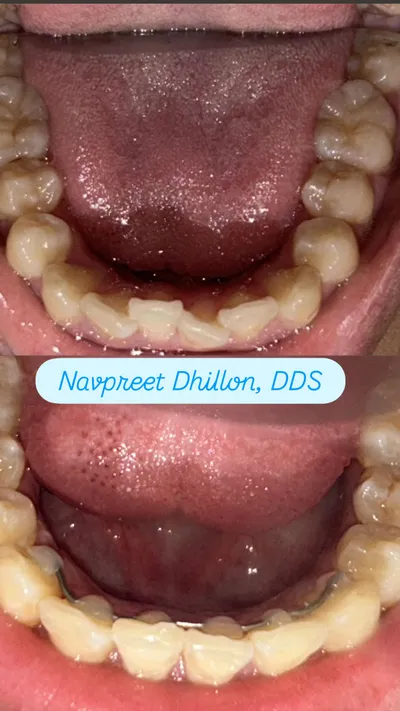 Before and after smile transformation 5