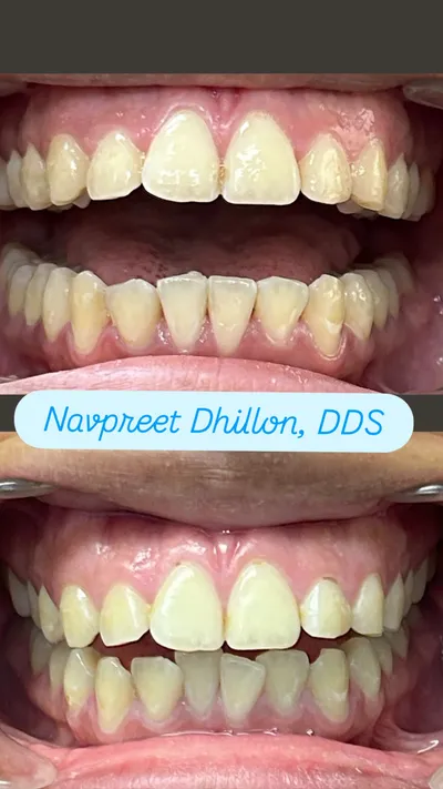 Before and after smile transformation 6